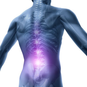 腰椎の椎間板の髄核が突出し、神経を圧迫する疾患